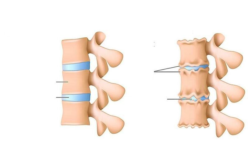 columna vertebral saudable e osteocondrose