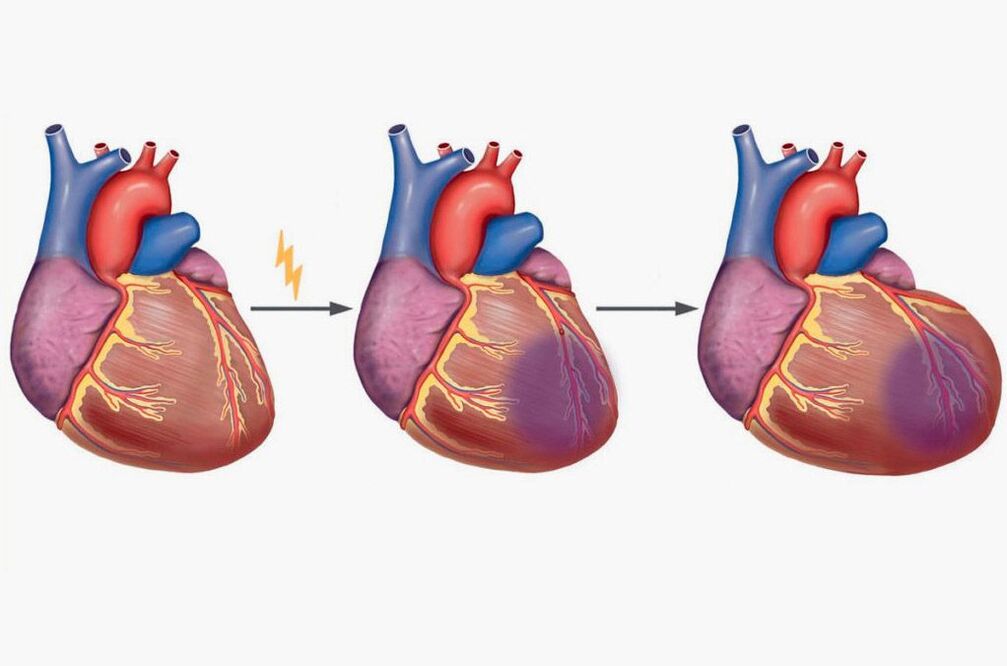 O infarto de miocardio leva a dor nos omóplatos