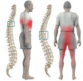 Pódese dar dor con condrose torácica ás extremidades inferiores e a entrepente