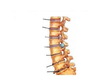 Síntomas da osteocondrose