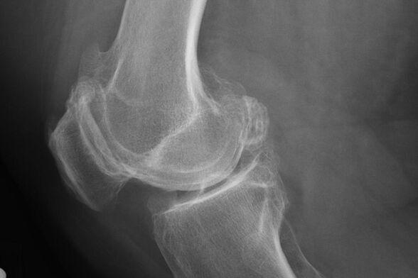 Métodos para diagnosticar a artrose do xeonllo