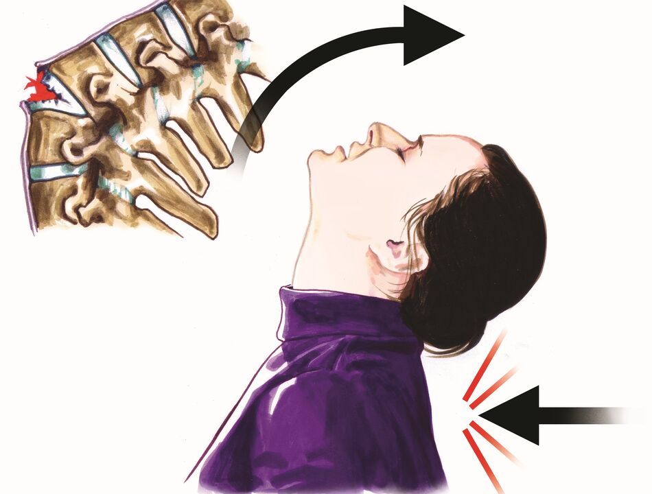 dano na columna vertebral como causa da dor no pescozo