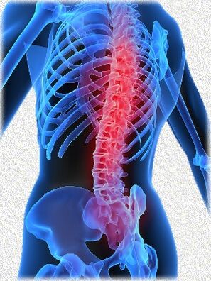 osteocondrose e métodos para o seu tratamento